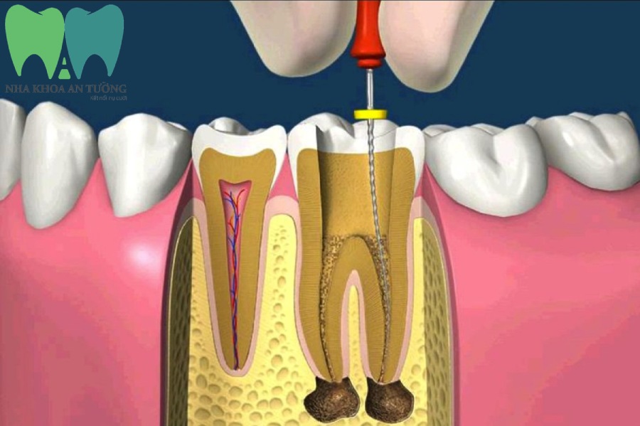 Triệu chứng sau khi lấy tủy răng