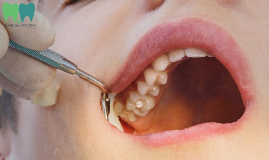 Nhổ răng hàm trên trong cùng bị sâu