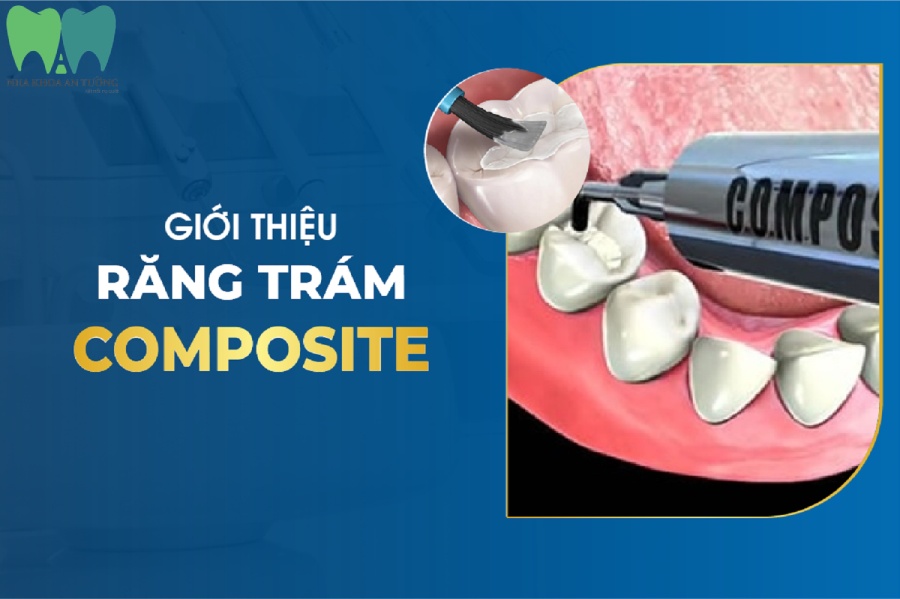 Trám răng Composite